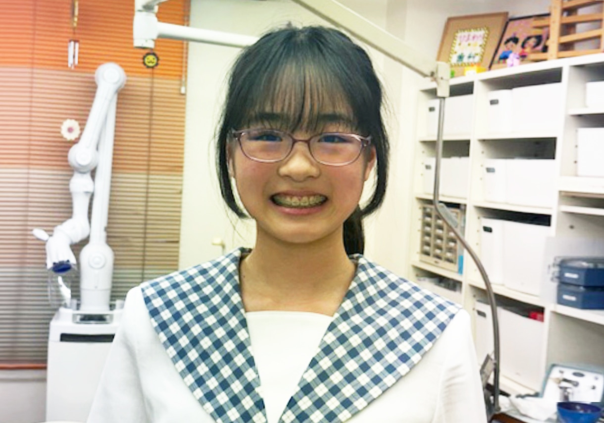 image:不正咬合の原因